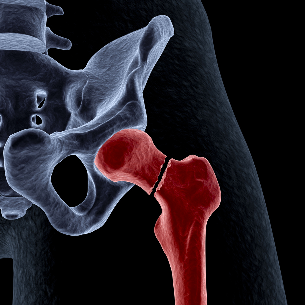 Illustration of a hip joint
