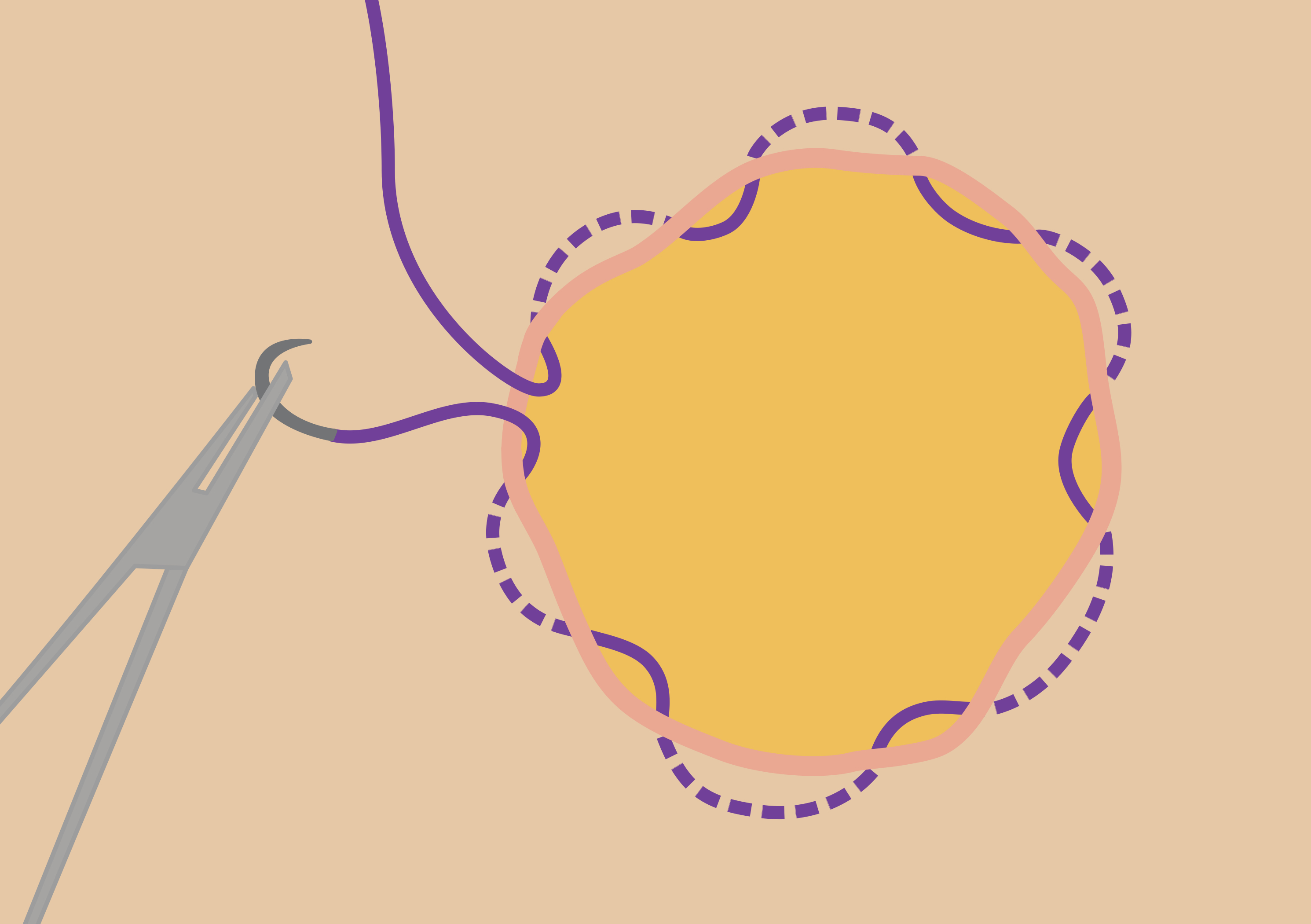 Comparing two methods of wound closure in stoma reversal: purse‐string closure versus linear skin closure.